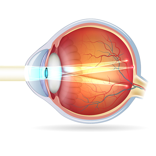 Astigmatism Diagram