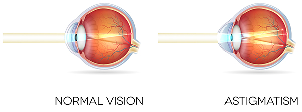 Normal vision vs vision with astigmatism