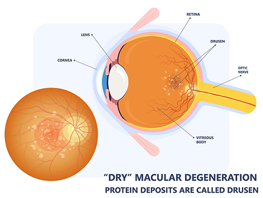 Diagram of Dry Macular Degeneration