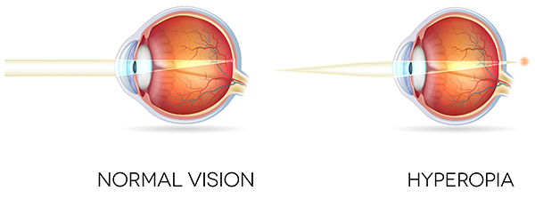 Normal vision vs vision with hyperopia