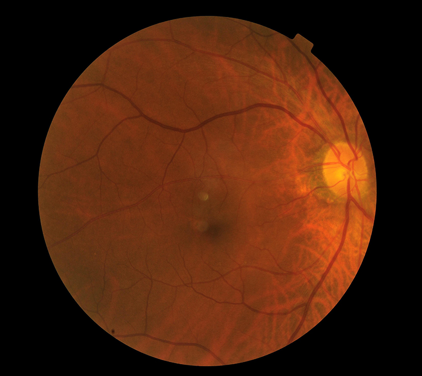 Retinal scan of macular degeneration