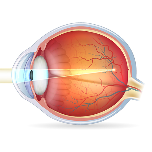 Myopia/ Nearsightedness Diagram