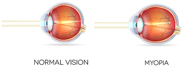 Normal vision vs vision with myopia