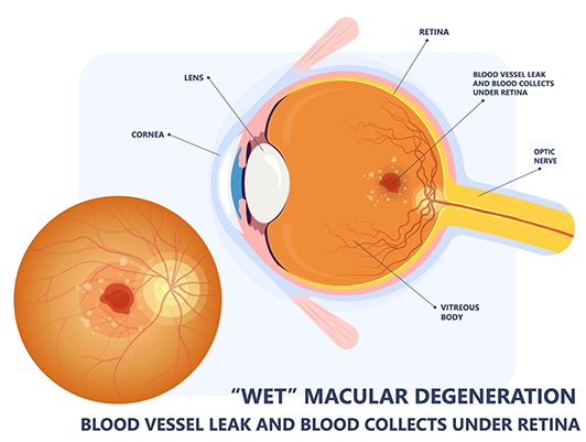 Diagram showing wet macular degeneration